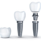 Detailed 3D Dental Implant Components Illustration